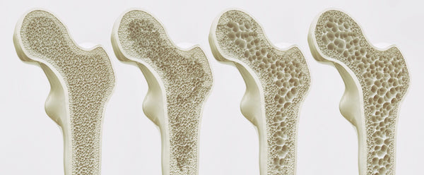 Understanding Osteoporosis