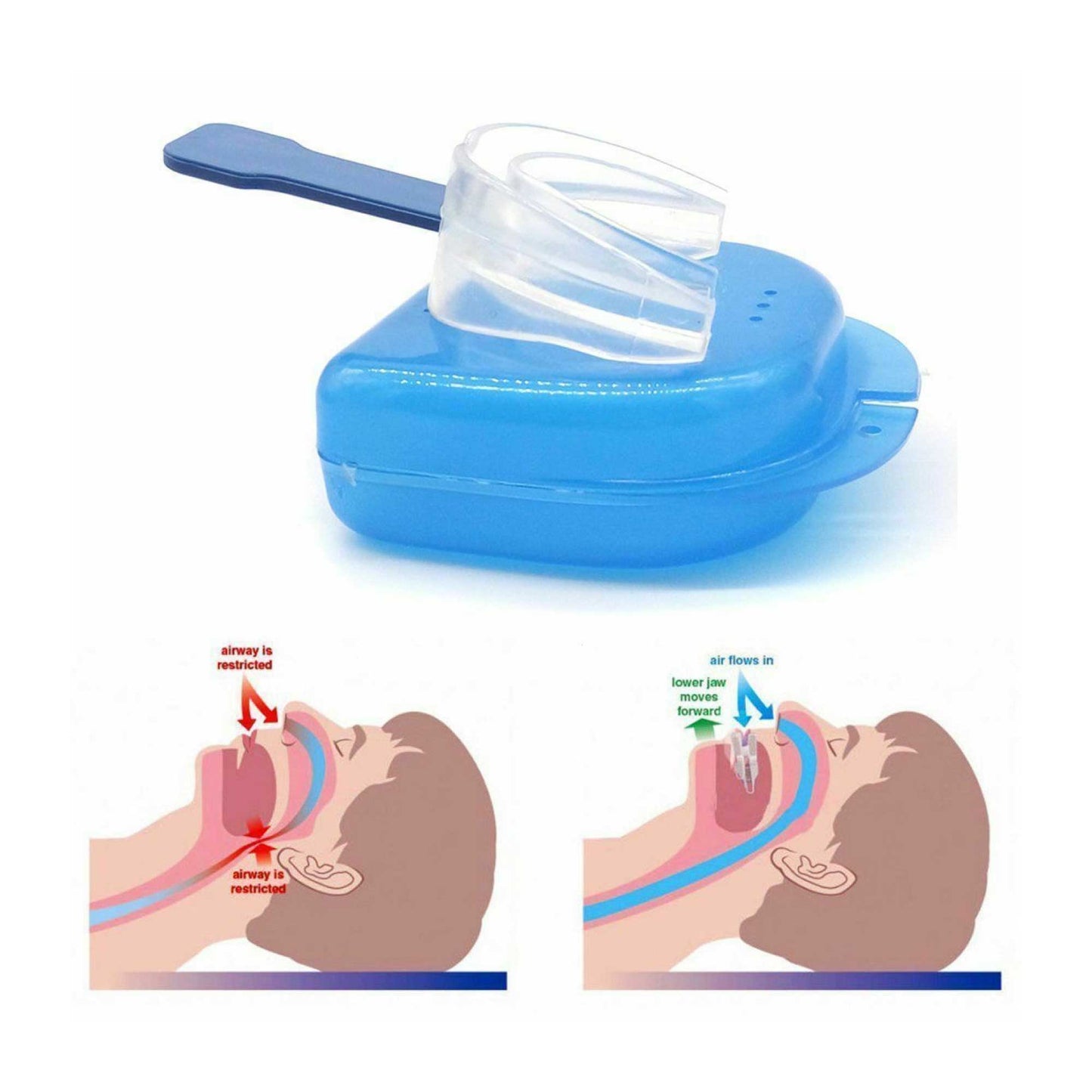Anti Snoring Aid Mouth Guard – Adjustable Sleeping and Breathing Mouthguard